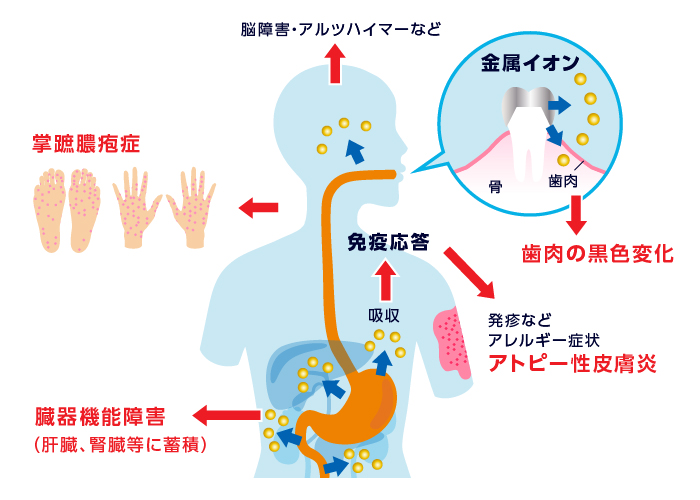 金属アレルギー説明画像