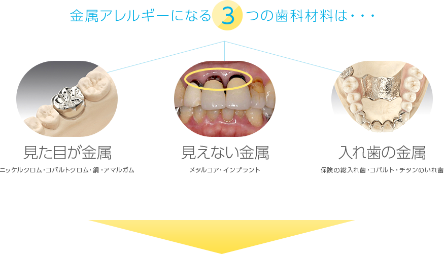 金属アレルギーになる3つの歯科材料は　見た目が金属（ニッケルクロム・コバルトクロム 銅・アマルガム）　見えない金属（メタルコア・インプラント）　入れ歯の金属（保険の総入れ歯 コバルト・チタンのいれ歯）