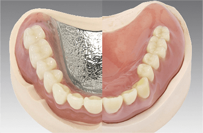 入れ歯の金属の交換